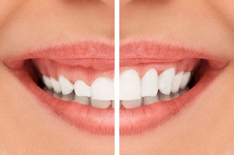 Diş Eti Estetiği (Gummy Smile) Hakkında Bilmeniz Gerekenler