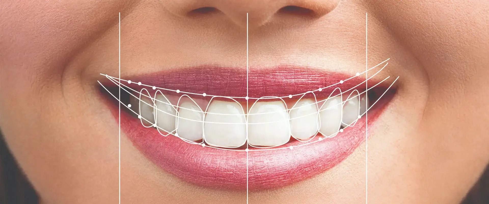 Hollywood Smile Nedir? Kalıcı mıdır?
